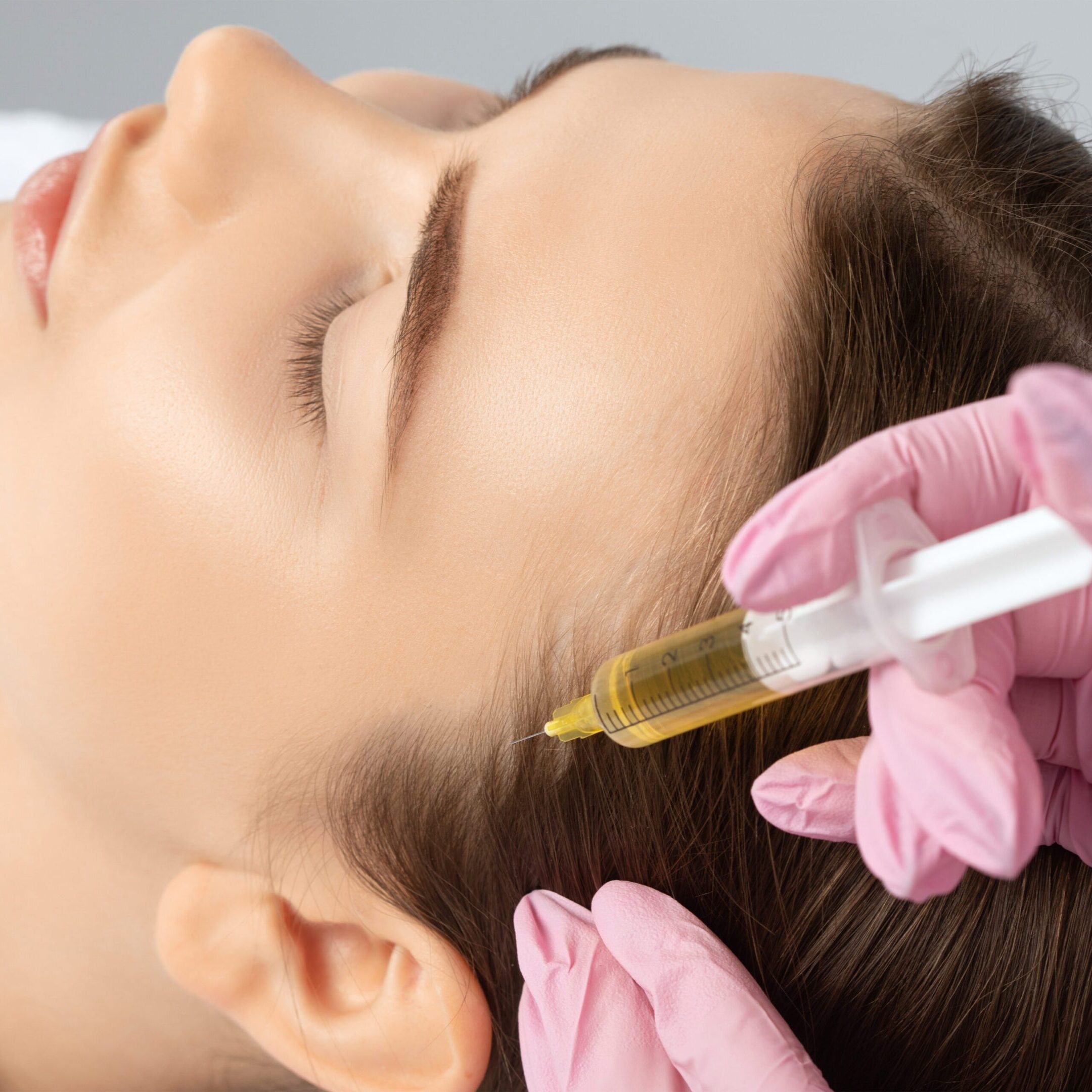 Cosmetologist does prp therapy against hair loss and anti-dandruff of a beautiful woman in a beauty salon. Aesthetic cosmetology concept, hair treatment. Cosmetologist does prp therapy against hair loss and anti-dandruff of a beautiful woman in a beauty salon. Aesthetic cosmetology concept, hair treatment.